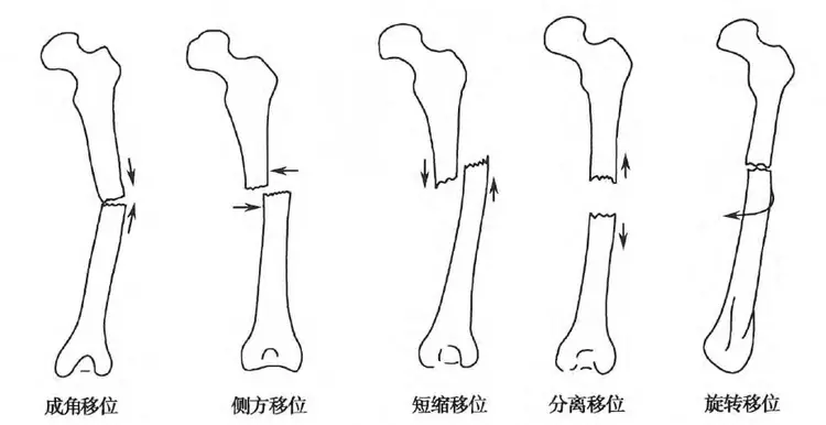 骨折