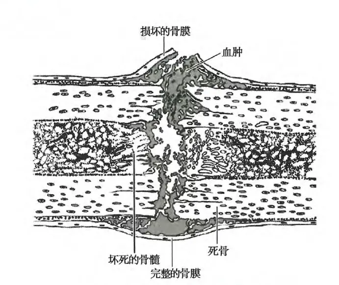 骨折